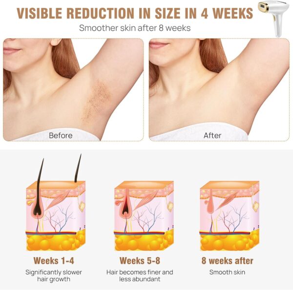 Beauty Professional Hair Removal IPL 3 en 1